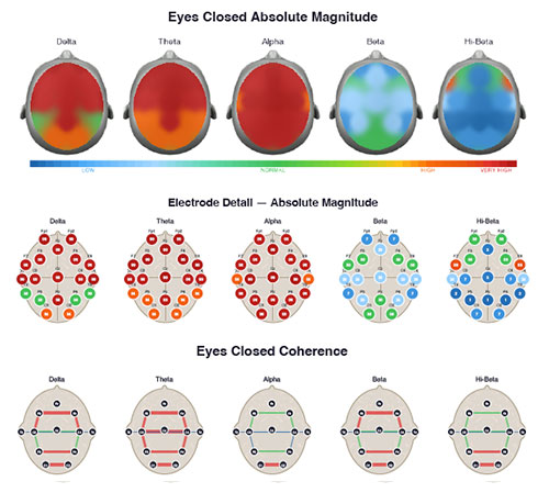 QEEG Brain Map Example